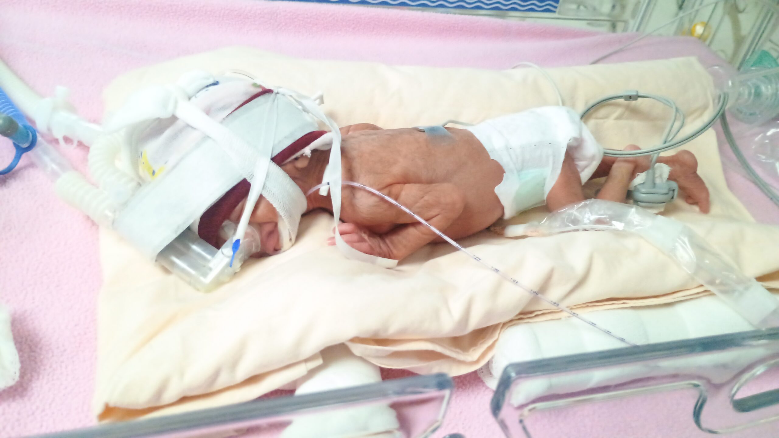 Premature baby treatment support for NICU care in Mumbai