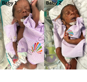 Twin Baby of Pushpa Success Story